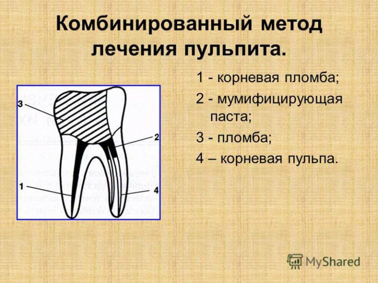 Методы лечения пульпита