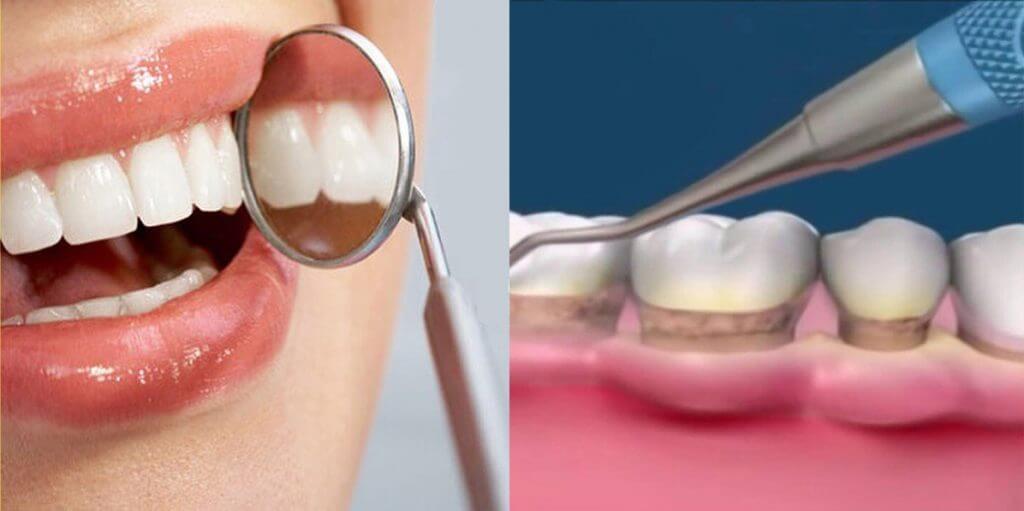 Где происходит скопление зубного налета?
