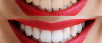 Причины разрушения эмали зубов