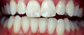Окрашивание зубов при флюорозе