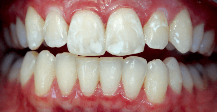 Окрашивание зубов при флюорозе