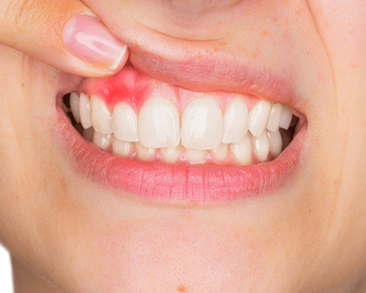 Как лечить зубной флюс?