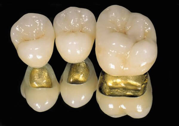 Применение металлокерамических протезов в стоматологии