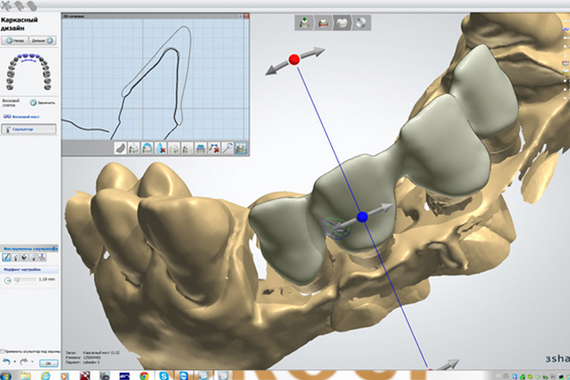 CAD/CAM система в стоматологии