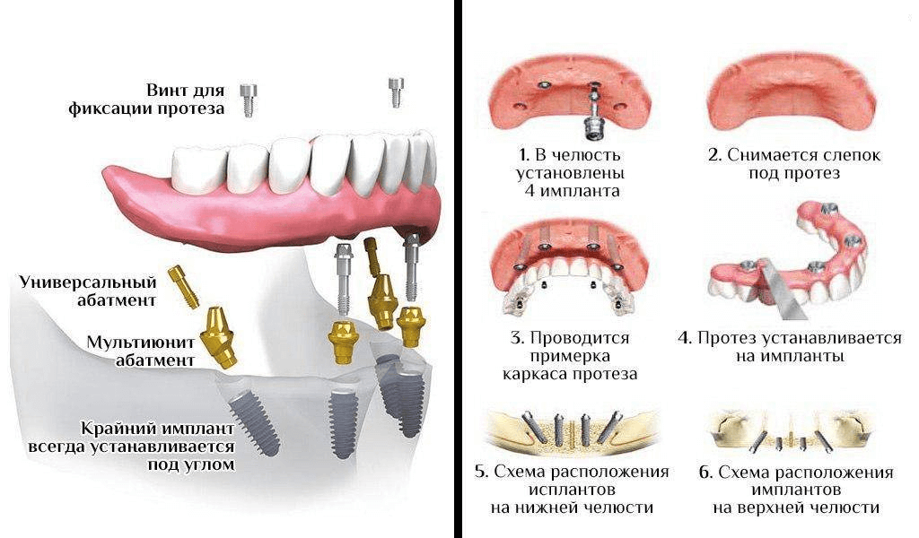 Стоматологическое протезирование зубов. Виды, этапы, способы протезирования.