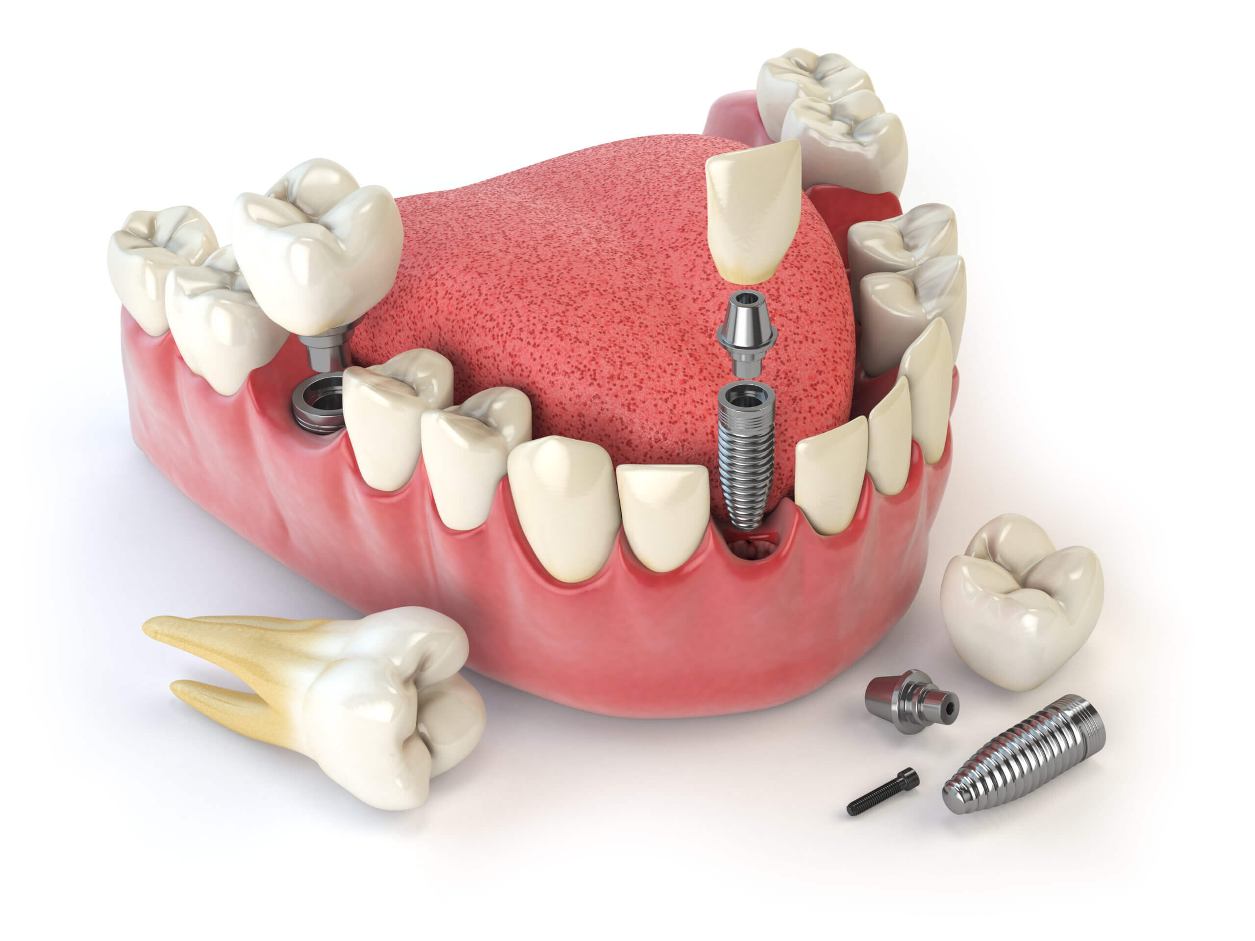 На что обратить внимание при выполнении протезирования зубов