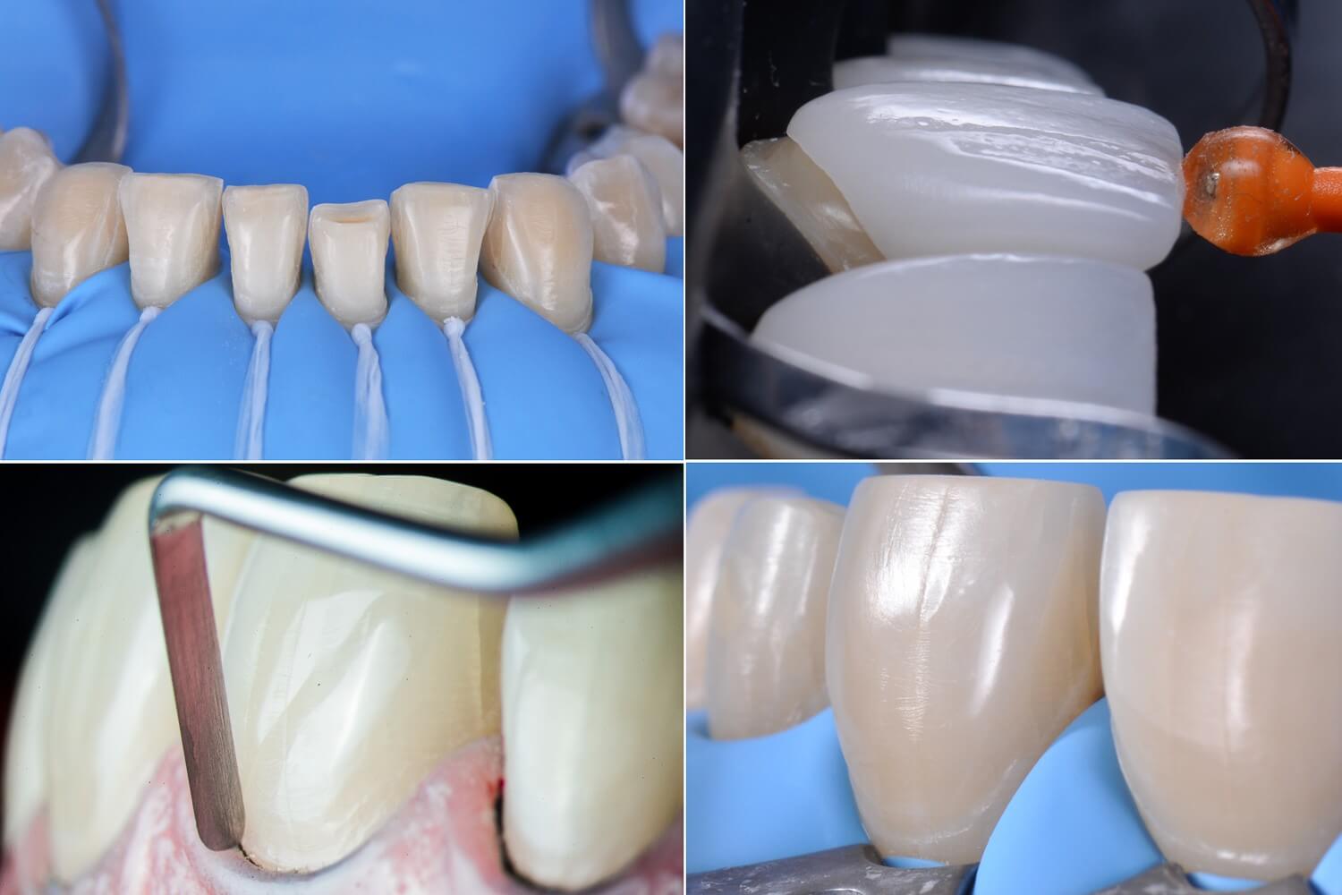 Применение люминиров в стоматологии