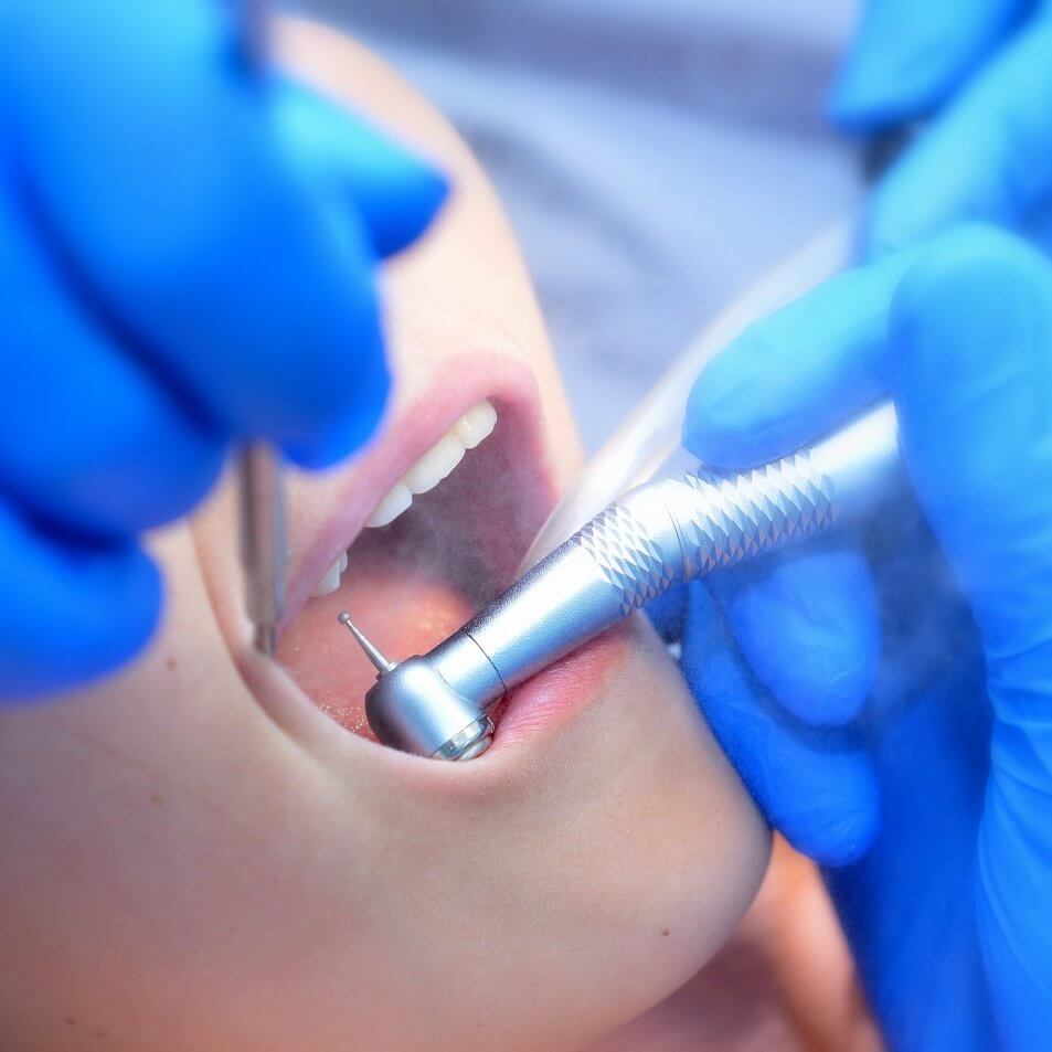 Эффективные методы лечения кариеса: сохранение здоровья зубов