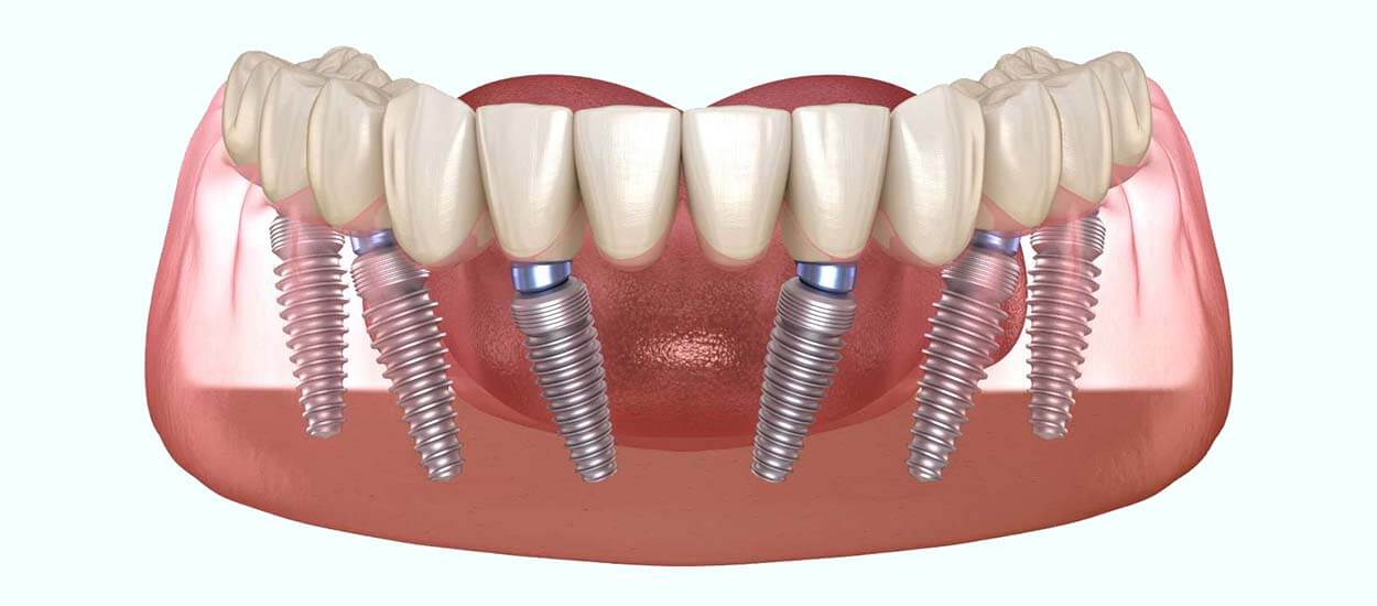 Современные технологии: протезирование на 6 имплантах - эффективное решение для полного восстановления зубного ряда