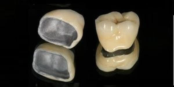 Все, что нужно знать о металлопластмассовых коронках: эффективное и долговечное решение для восстановления зубов