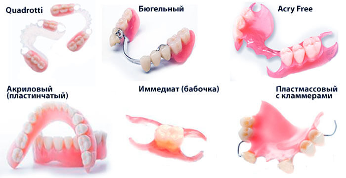 Основные типы услуг протезирования зубов