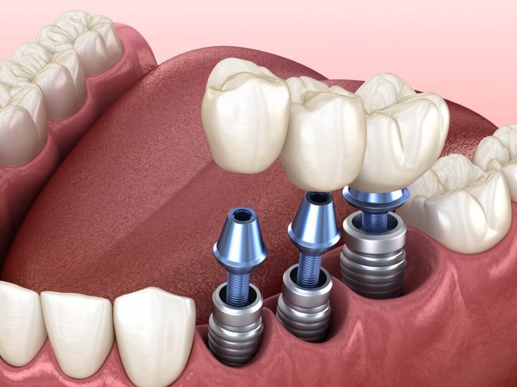 Имплантация зубов: современные методы восстановления улыбки и полезные советы для пациентов