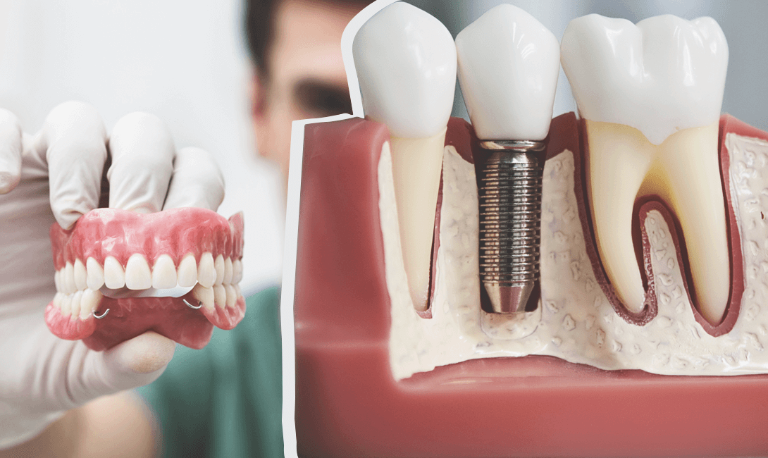 Профессиональная имплантация зубов: неотъемлемая часть современной стоматологии
