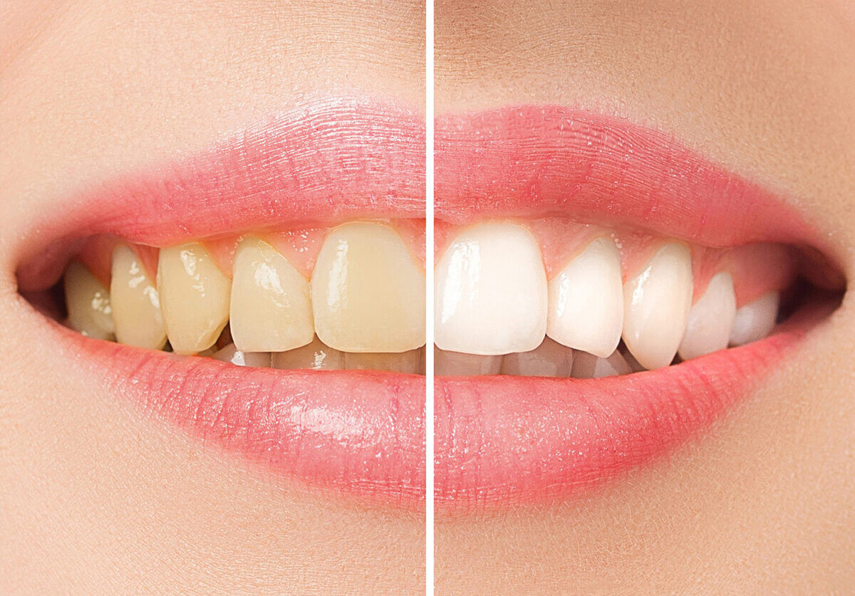 Отбеливание зубов: секреты сияющей улыбки