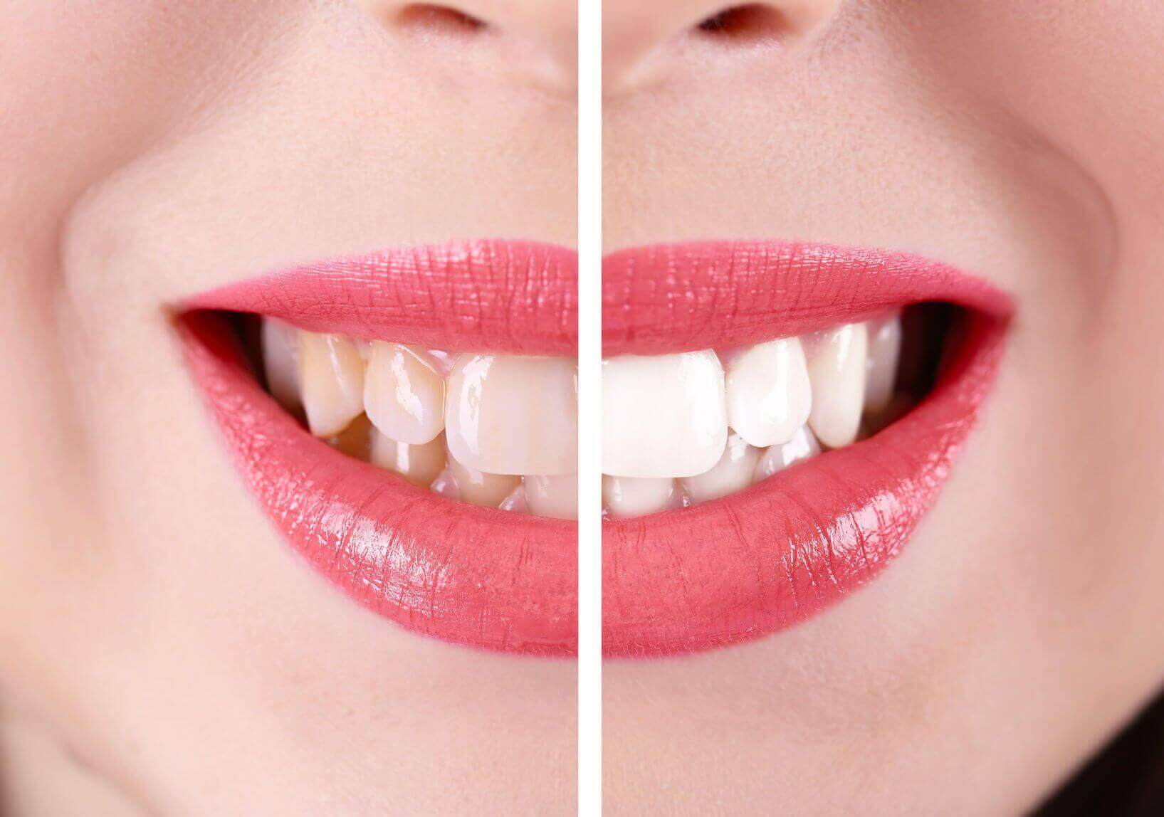 Отбеливание зубов: эффективные методы и советы для белоснежной улыбки