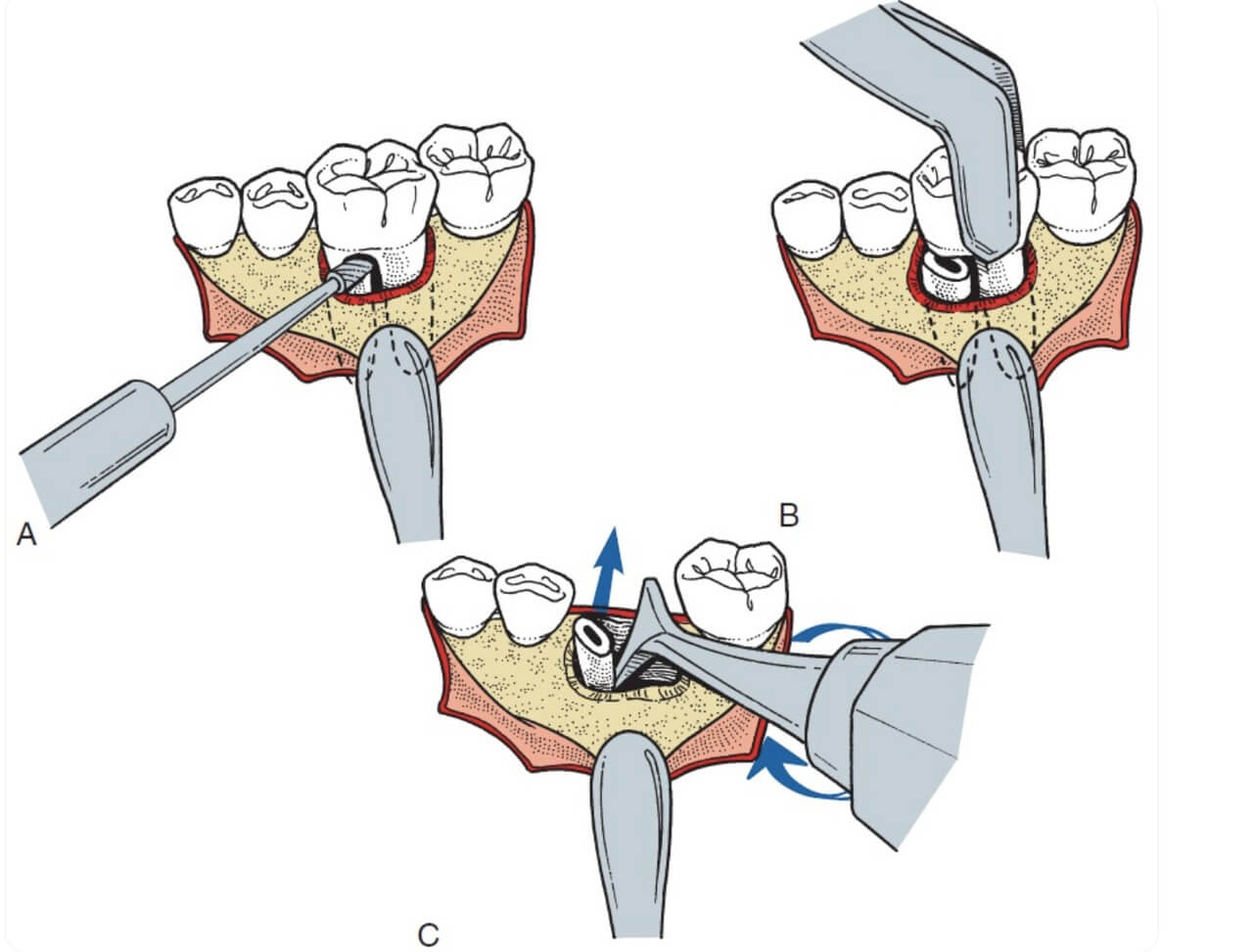 Как удалить зуб безболезненно и эффективно: подробная инструкция