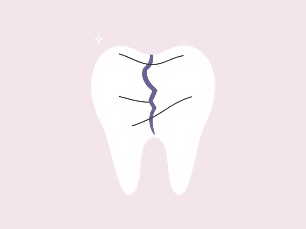     Cracked tooth: Emergency steps. Managing Pain While Waiting for Dental Care