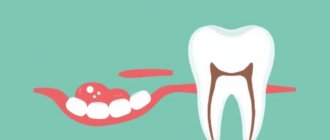 Abscessed Tooth: Danger Signs You Should Never Ignore