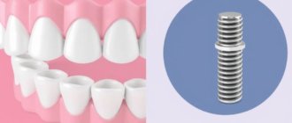 Bridge oder Implantat? Wie Sie die richtige Entscheidung treffen (Comment choisir entre un bridge et un implant ?)
