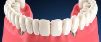 All-on-4®: Fester Zahnersatz an nur vier Implantaten — La solución que cambia sonrisas en un día