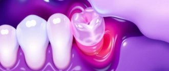 Caries: causas, prevención y tratamientos actuales — lo que debes saber para proteger tu sonrisa