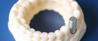 Missing a Tooth? Zahnersatz: Brücke, Teilprothese oder Implantat — Which One Fits You?