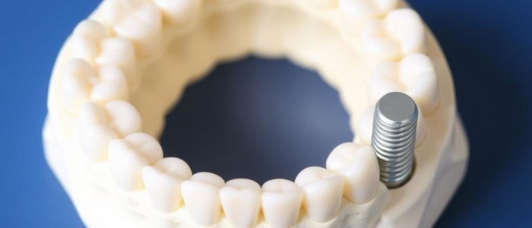 Missing a Tooth? Zahnersatz: Brücke, Teilprothese oder Implantat — Which One Fits You?