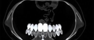 КТ зубов: что это, когда нужно и как к ней подготовиться