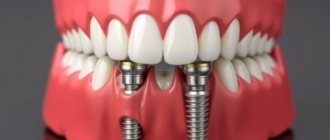 Зубные импланты: как вернуть уверенную улыбку и не запутаться в технологиях