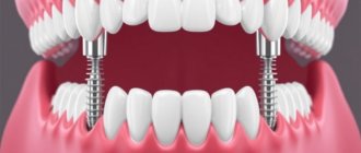 All-on-4: как вернуть зубы за один визит и не потерять спокойствие