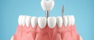 Базальная имплантация зубов: когда хочется жевать сразу и без костной пластики
