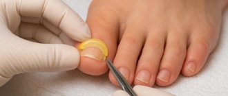 Podofix: как исправить вросший или деформированный ноготь без операции и лишних страхов