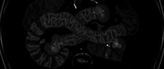 МРТ кишечника: что это за исследование и когда оно действительно нужно