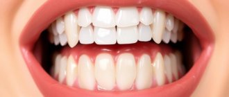 Виниры на зубы: как получить улыбку, которую не хочется прятать