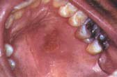 элементы поражения слизистой оболочки рта и красной каймы губ.