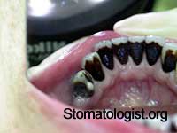 Пигментация зубов и налеты