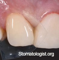 Особенности препарирования твердых тканей зуба при пломбировании композитными материалами.
