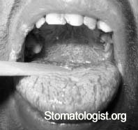 Изменения слизистой оболочки рта при лучевой терапии новообразований челюстно-лицевой области