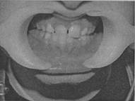 Соотношение сегментов зубных дуг по Герлаху