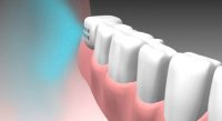 Изготовление искусственного зуба в полости рта. 
