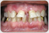 Избирательное пришлифовывание зубов при заболеваниях пародонта
