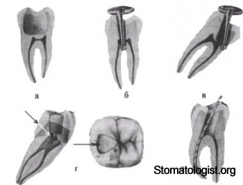 Полость зуба и ее препарирование Часть 4