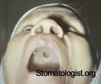 Проявление сифилиса в полости рта