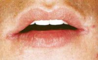 проявления первичного сифилиса в полости рта