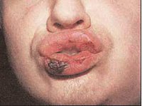 проявления третичного сифилиса в полости рта