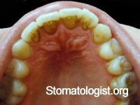 Изменения слизистой оболочки рта при заболеваниях желудочно-кишечного тракта