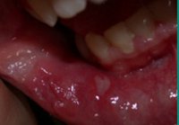 Анемия железодефицитная гипохромная.Проявления в полости рта