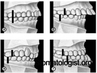 Возрастные особенности зубочелюстной системы у детей в норме и при сагиттальных аномалиях прикуса. 