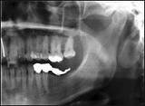 Панорамная рентгенография в ортодонтии