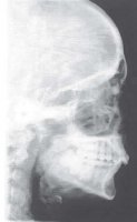 Изучение взаимосвязи размеров и формы лицевого отдела черепа и зубоальвеолярных дуг. 